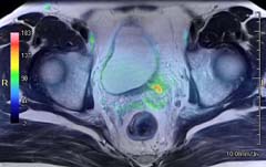 図2：骨盤部MRI融合画像