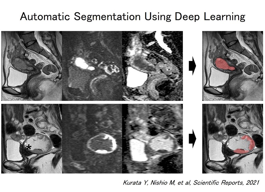 Automatic Segmentation Using Deep Learning